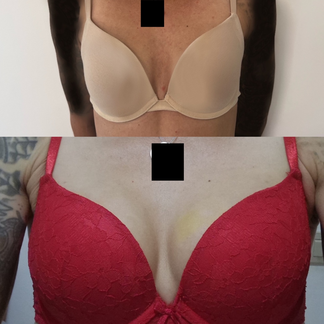 carolyn jill robinson recommends Huge Boob Plumpers