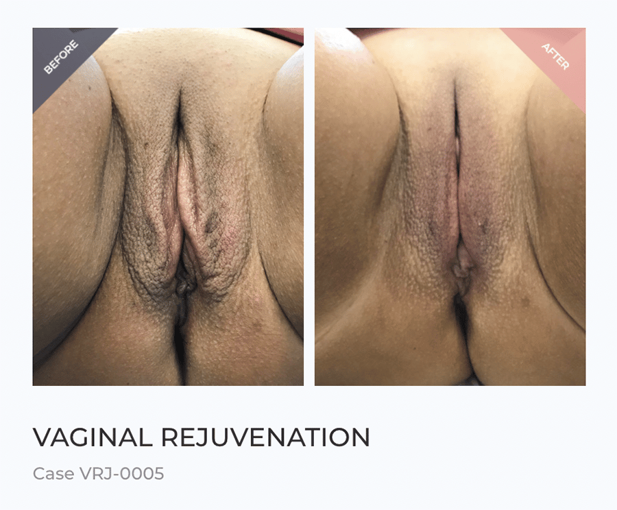 abba americana recommends flabby pussy pic